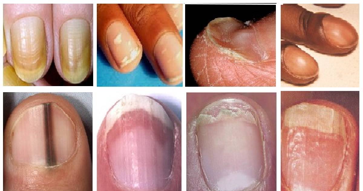half and half nail syndrome