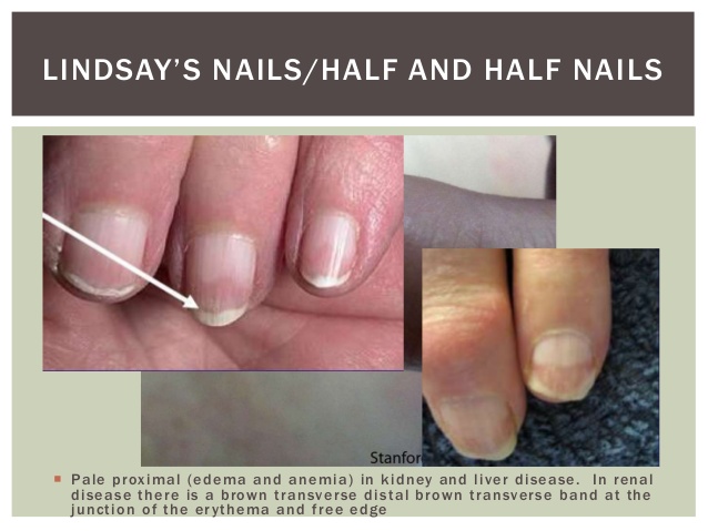 half and half nail syndrome | capillaroscopy,nailfold capillaroscopy, fingernail under microscope,nail fold capillaroscopy,nailfold capillary  microscopy