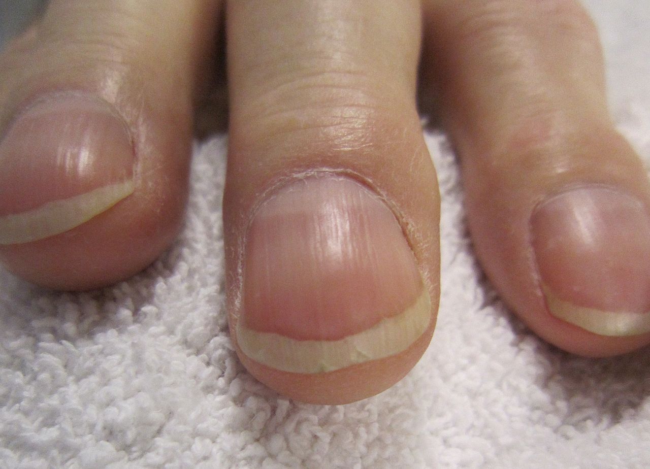 Why proximal nail fold skin peeling