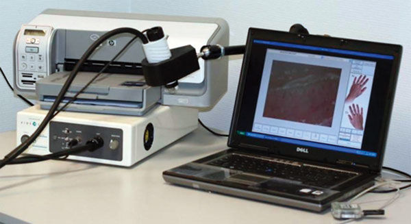 nailfold microcirculation microscope