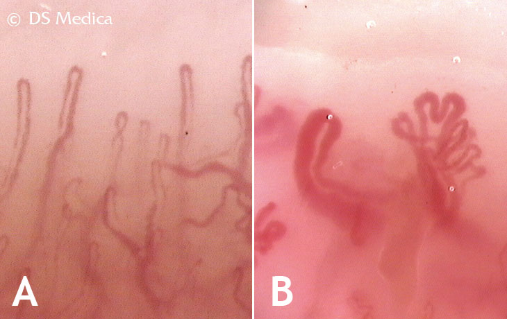 nailfold capillaroscopy images