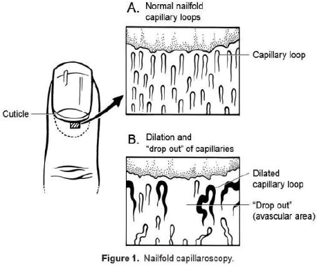 nailfold capillaroscopy positive in secondary raynauds