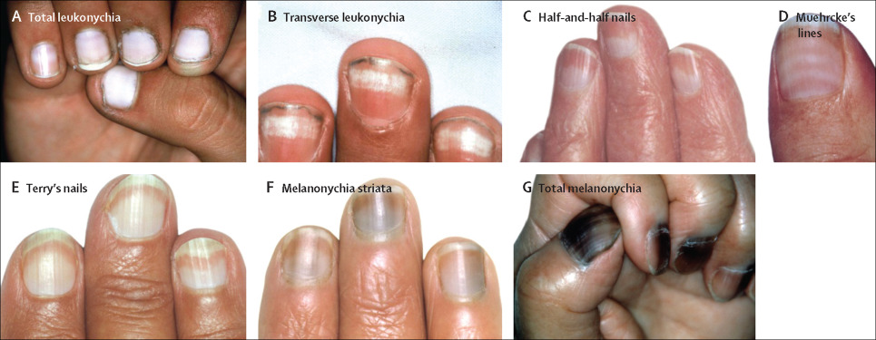 infection of nail fold