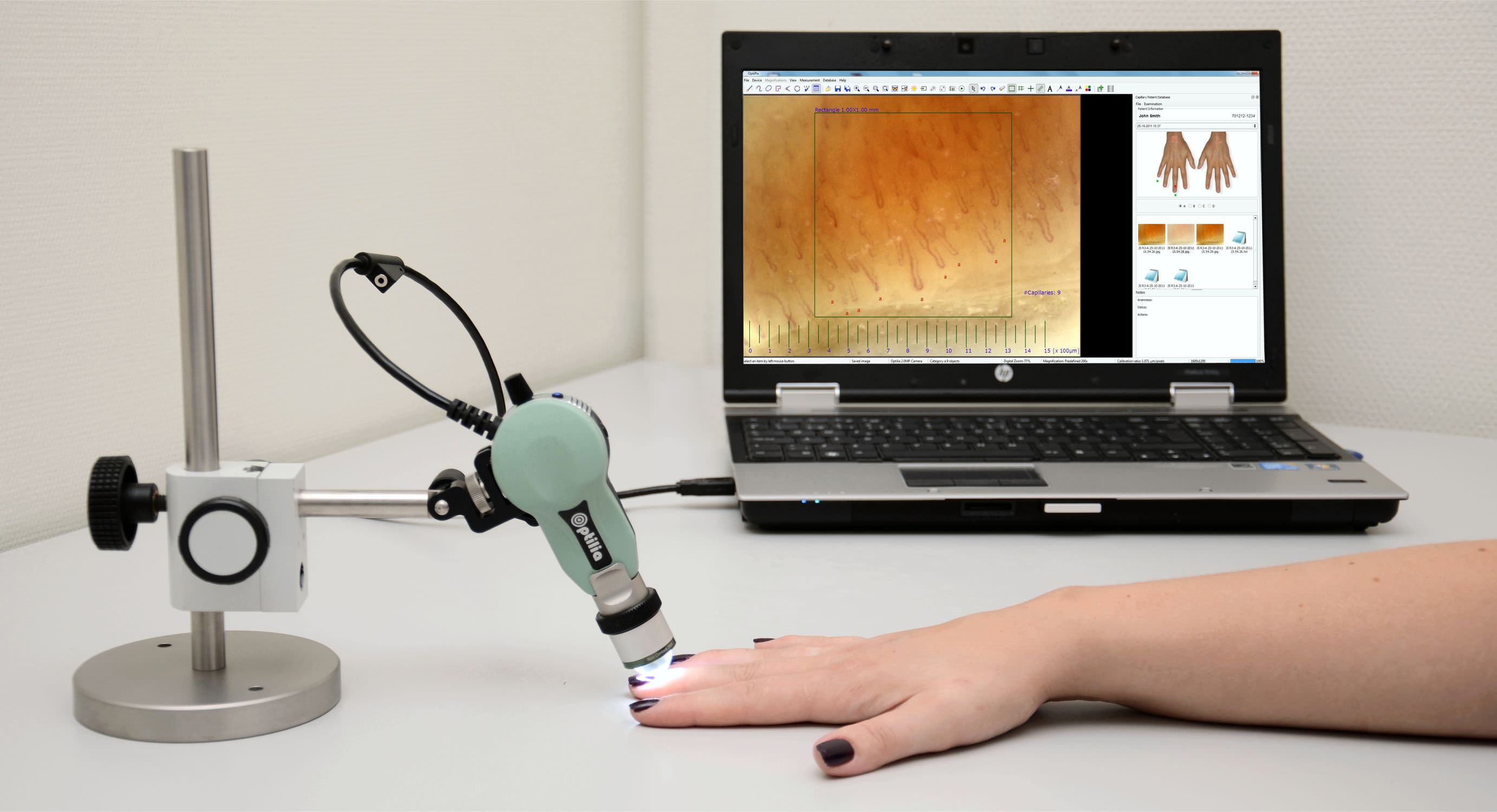 nail fold capillary microscope microcirculation microscope video microscope