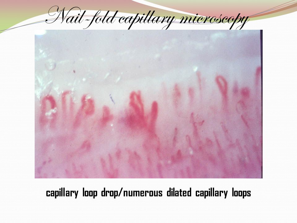 nailfold capillary microscopy