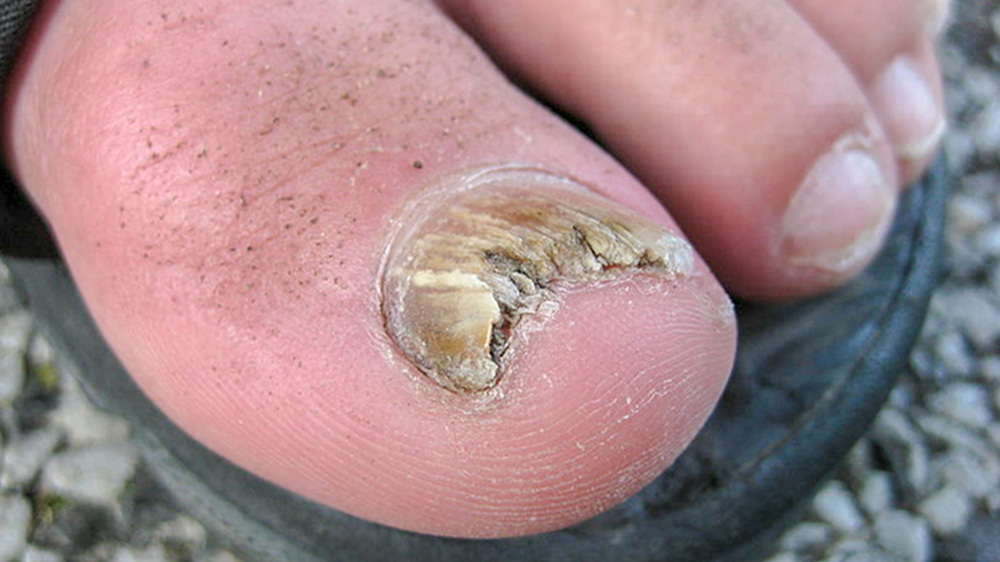 fungal nail under microscope
