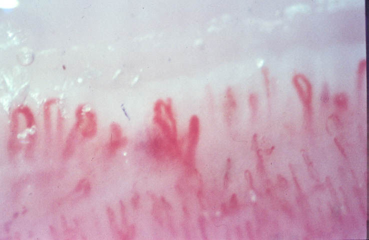 Microscope Nail Blood Circulation