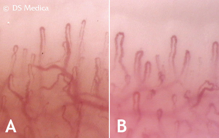 nailfold capillaroscopy images