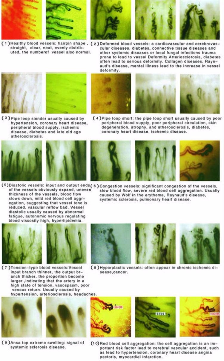 Nailfold Capillaroscopy Test Cost
