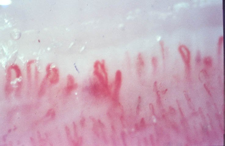 Nailfold Capillary Dilatation