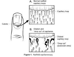 Nailfold Capillary Dilatation