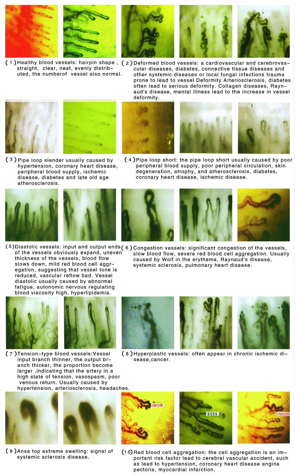 nail bed capillaroscopy