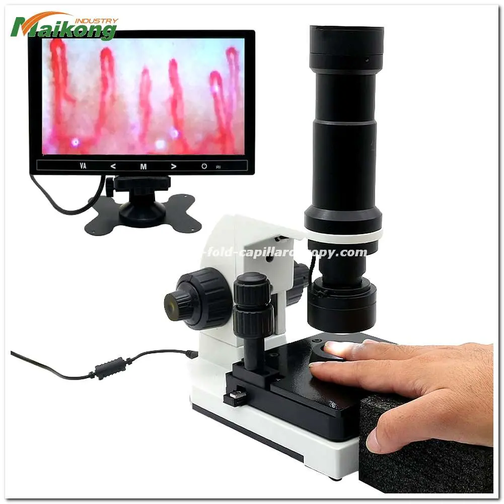 Nailfold Capillaroscopy in Raynaud's Disease