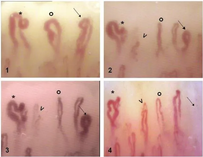 Suppliers of Nailfold Capillaroscopy Equipment for U.S. Preventive Health Centers — nail fold vasculature capillaroscopy 3 - 副本.JPG