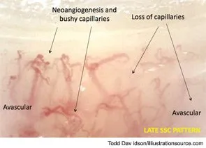 Dilated Nailfold Capillaries: What Portable Capillaroscopy Shows U.S. Clinicians — nail fold microscopy 6 - 副本.jpg