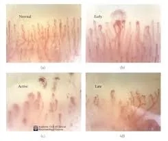 Dilated Nailfold Capillaries: What Portable Capillaroscopy Shows U.S. Clinicians — nail fold microscopy 7 - 副本.jpg
