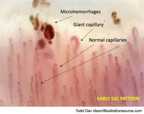 Dilated Nailfold Capillaries: What Portable Capillaroscopy Shows U.S. Clinicians — nail fold microscopy 4 - 副本.jpg