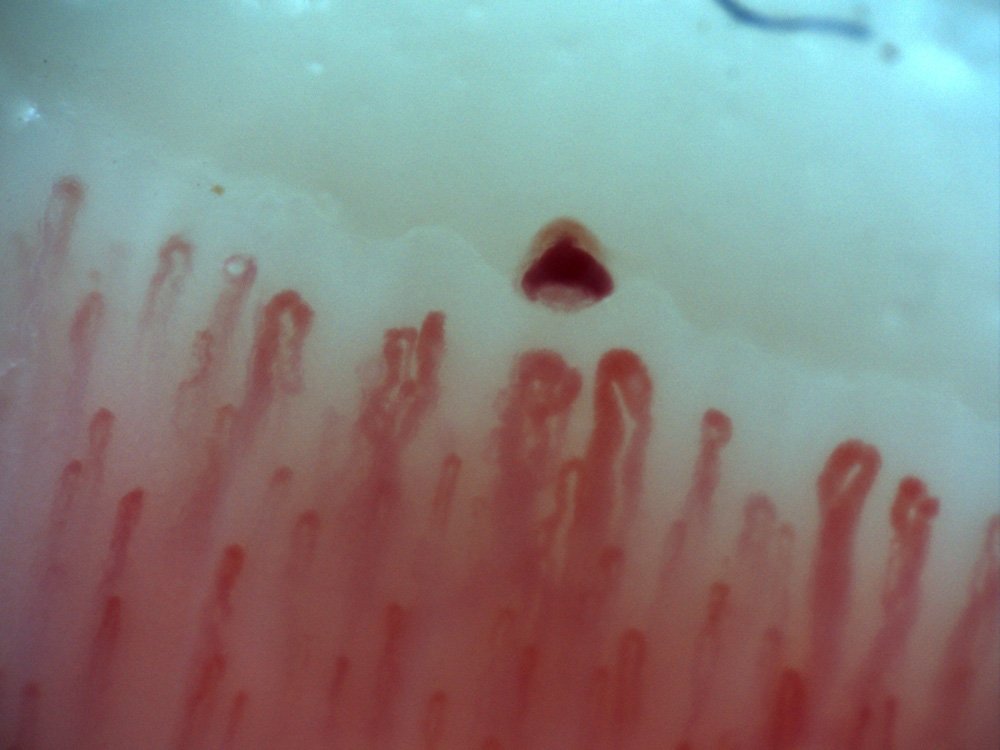 Sample nailfold capillaroscopy image