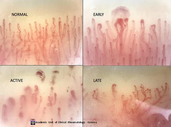 Portable vs Benchtop Nailfold Capillaroscopy — direct answer for U.S. clinics — nail fold microscopy 5 - 副本.jpg