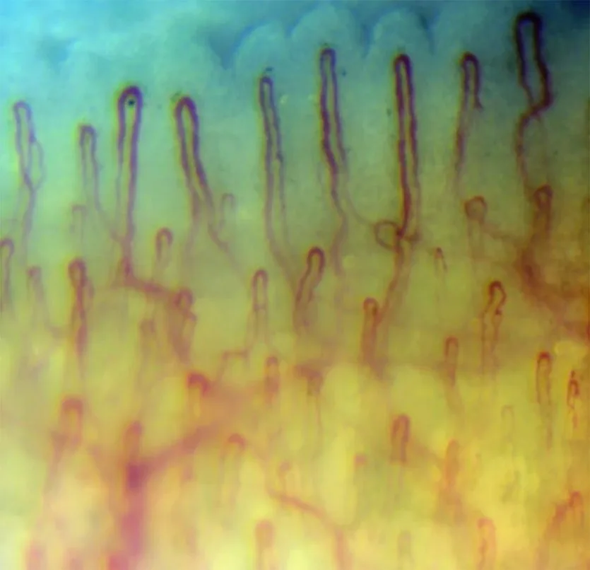 nailfold capillaroscopy microscope MK-0001 — scleroderma nail changes (3).jpg