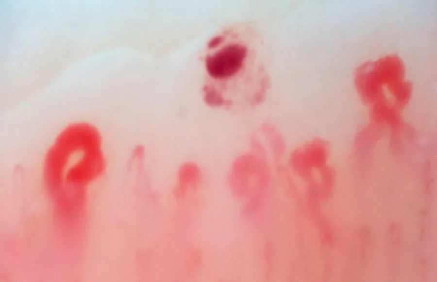 How occupational health clinics in the U.S. choose a reliable capillaroscopy equipment supplier — nail fold vasculature capillaroscopy 10 - 副本.JPG